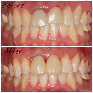 Smile Makeover