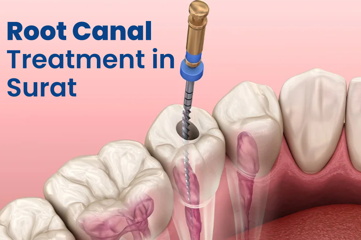 Facts And Myths Of Root Canal Treatment You Should Know