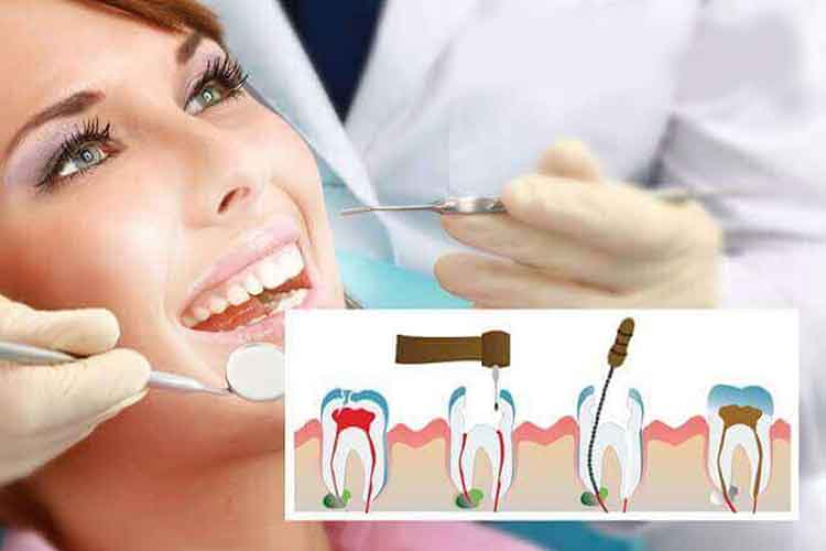 Root Canal Treatment Designed for Eliminating Bacteria from the Infected Teeth