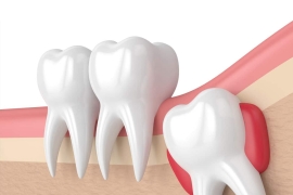 Perfect Surgical Procedure for Extraction of Wisdom Tooth in a Painless Process