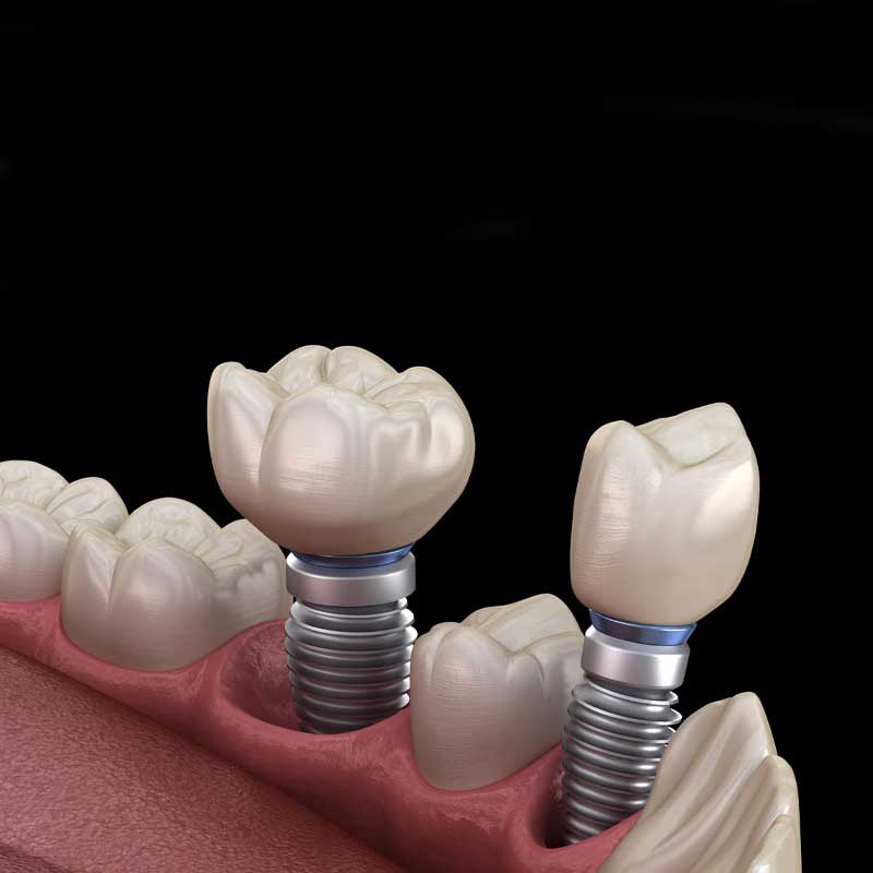 Dental Implant in Adajan