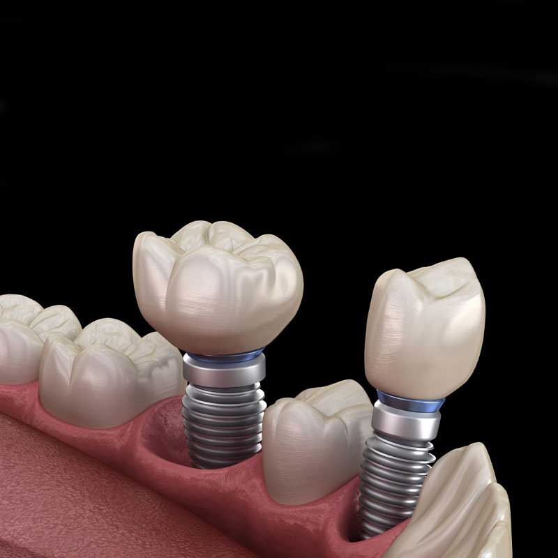 Dental Implant in Ghod Dod Rd