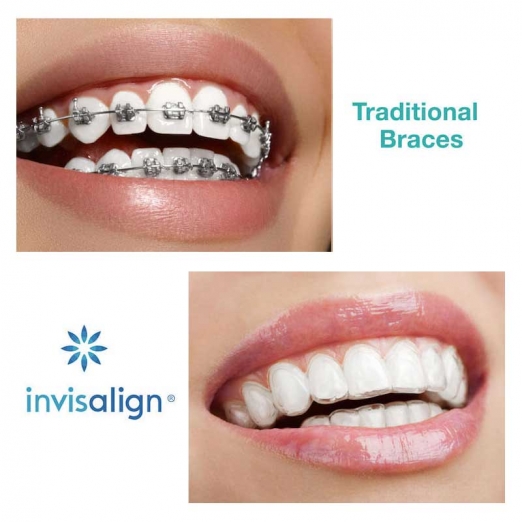 Clear Aligners in Ashwini Kumar Rd