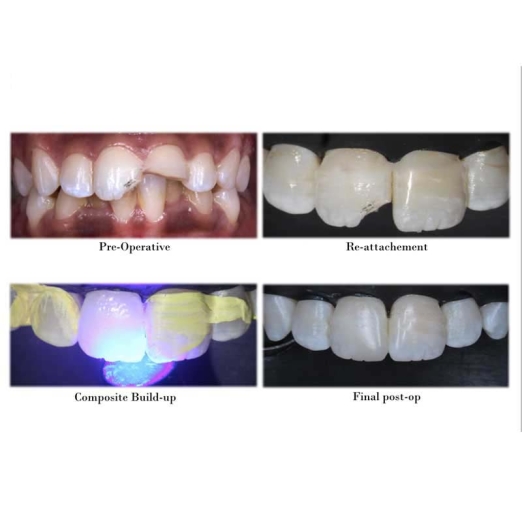 Cosmetic Tooth Colored Fillings in Ena