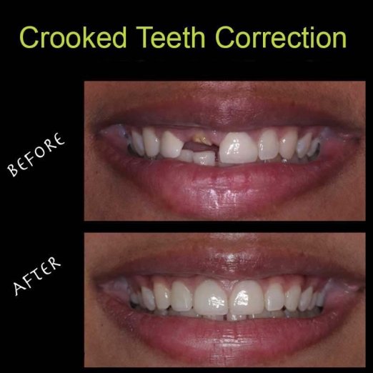 Crooked Teeth Correction in Ena