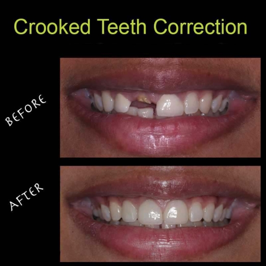 Crooked Teeth Correction in Uttran