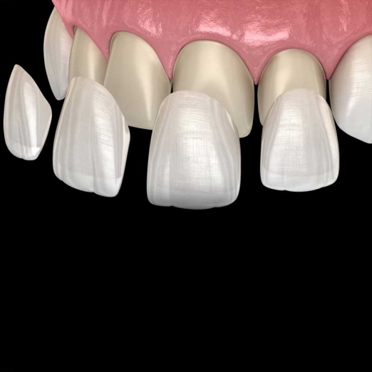 Dental Veneers in Ena