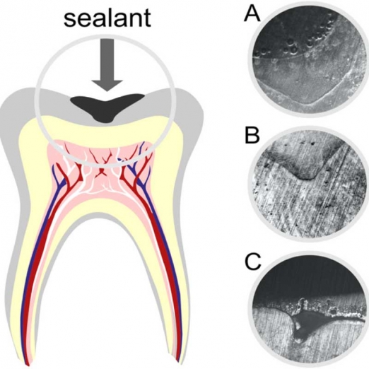 Fluoride Fillings in Variav