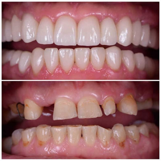 Full Mouth Rehabilitation in City Light Road