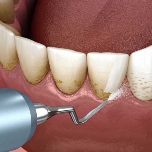 Full Mouth Scaling & Polishing in Ena