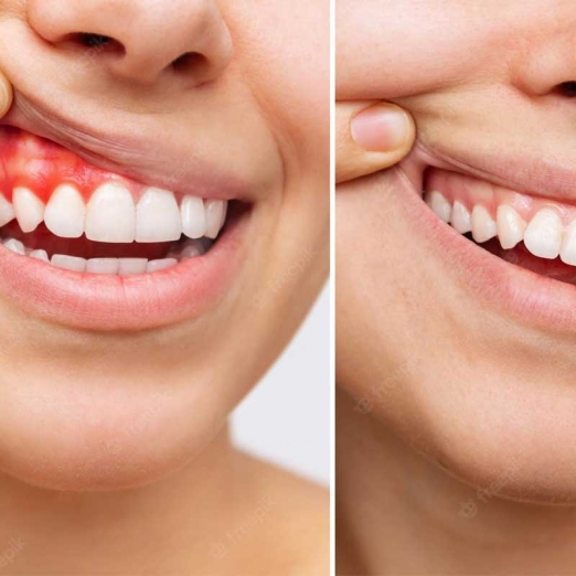 Gum Treatment in Bhestan