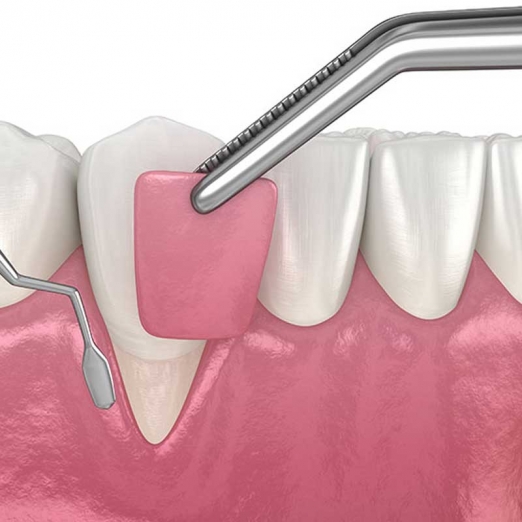 Gums Surgery in Athwalines