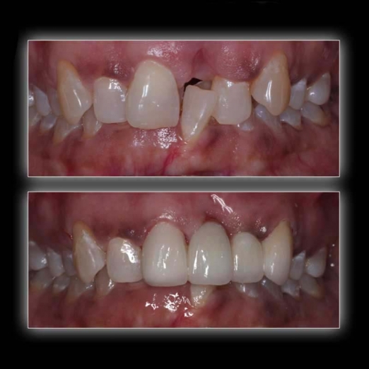 Jetting Out Teeth Correction in Uttran