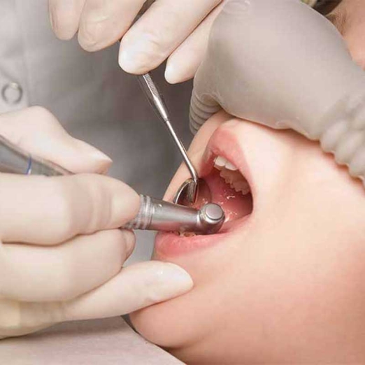 Kids Root Canal Treatment in Chikhli