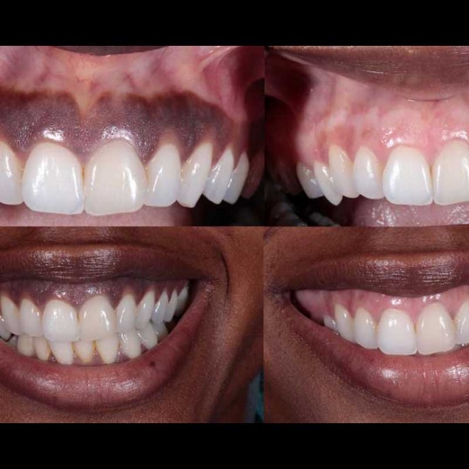 Laser Gums De Pigmentation in Vyara