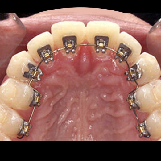 Lingual Braces in Athwa