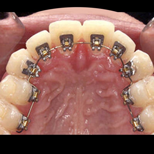 Lingual Braces in Parvat Patiya