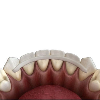 Mobile Teeth Solution with Splinting in Dumas