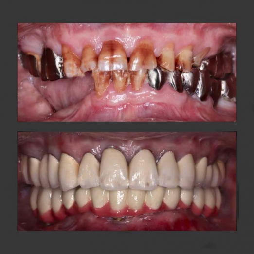 Mottling of Teeth Correction in Uttran