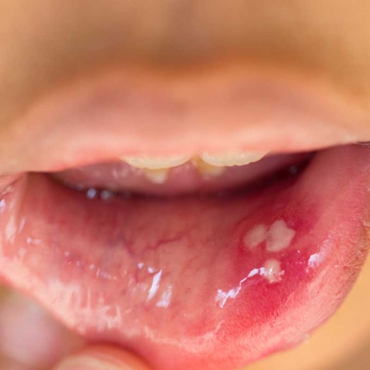 Mouth Ulcers in Nana Varachha