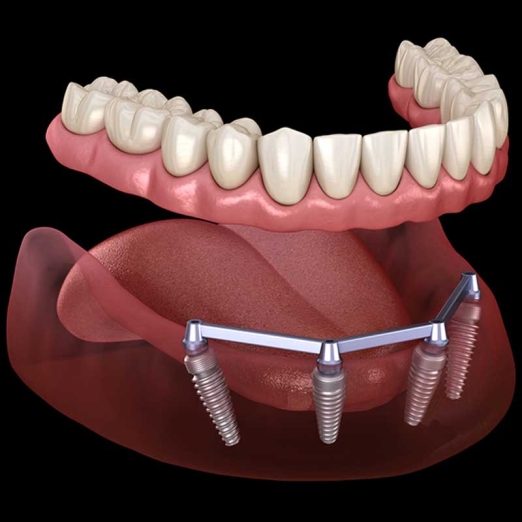 Multiple Teeth Implants in Bhatena