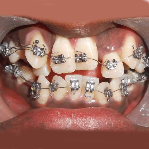 Orthodontics Treatment in Surat
