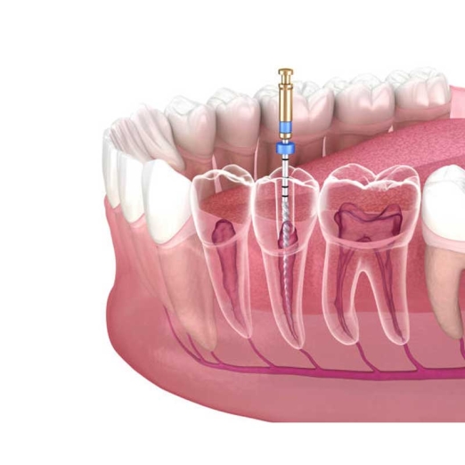 Root Canal Treatment in Chikhli