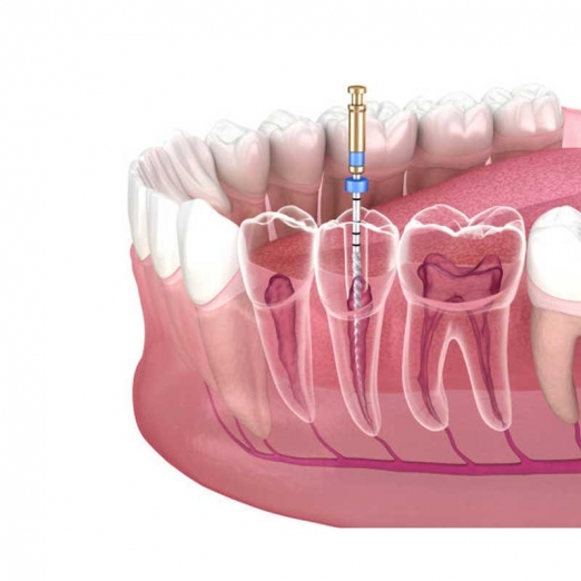 Root Canal Treatment in Salabatpura