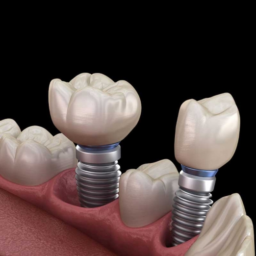 Single Tooth Implant in Vesu Canal Rd