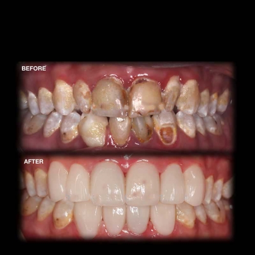 Smile Makeover in Uttran