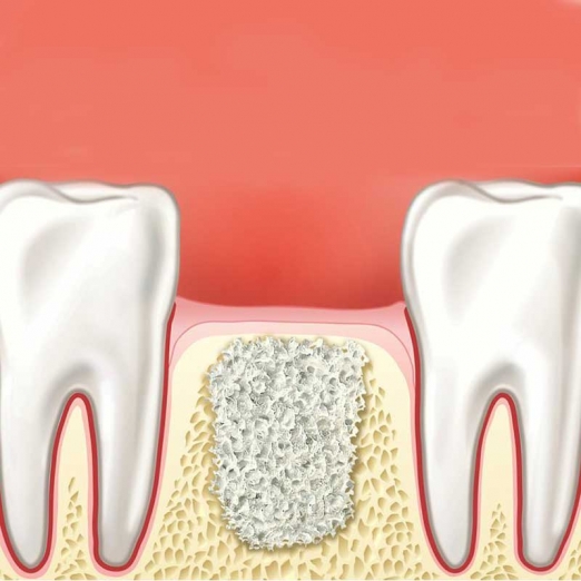 Socket Preservation Therapy in Panas