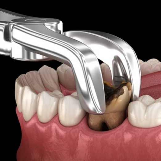 Tooth Extraction in Ena