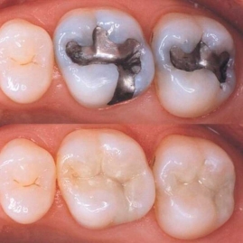 Dental Care Treatments in Bamroli