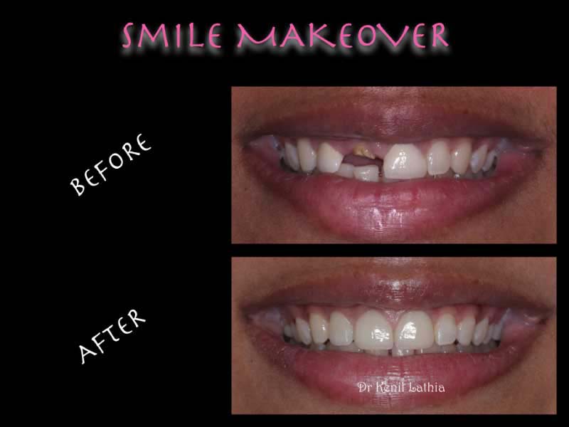 CROOKED TOOTH CORRECTION