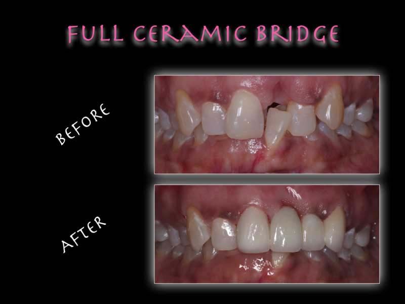 JETTING OUT TEETH CORRECTION